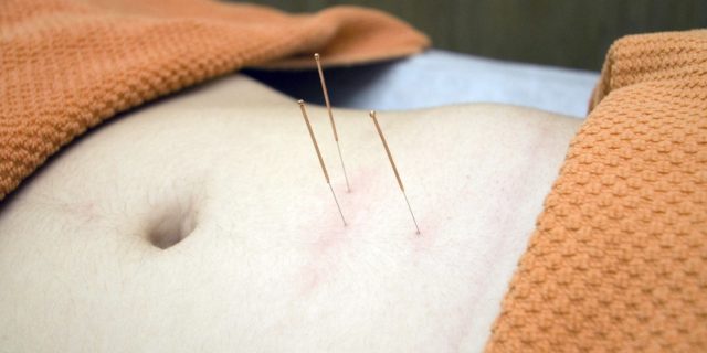 Acupuncture Treatments for Infertility