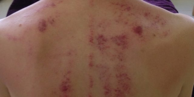 Gua Sha (Chinese Scraping)