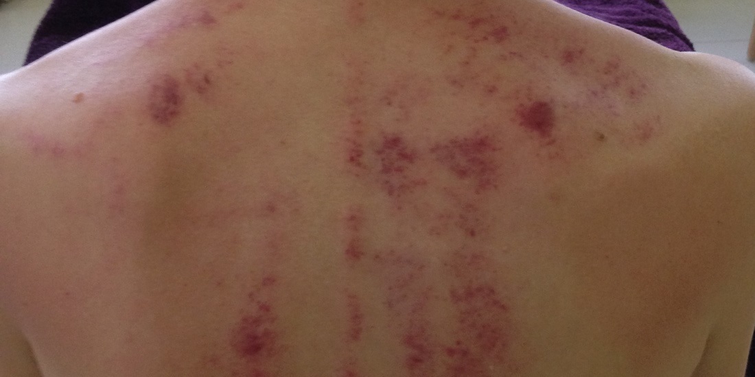 What is Gua Sha or Chinese Scraping? | TCM
