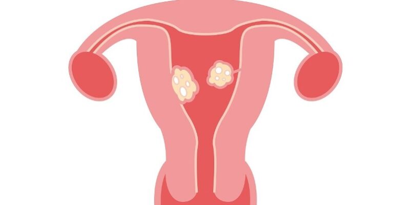 Uterine Fibroids