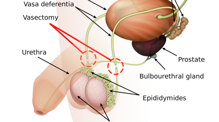 Vasectomy and Vasectomy Reversal Explained