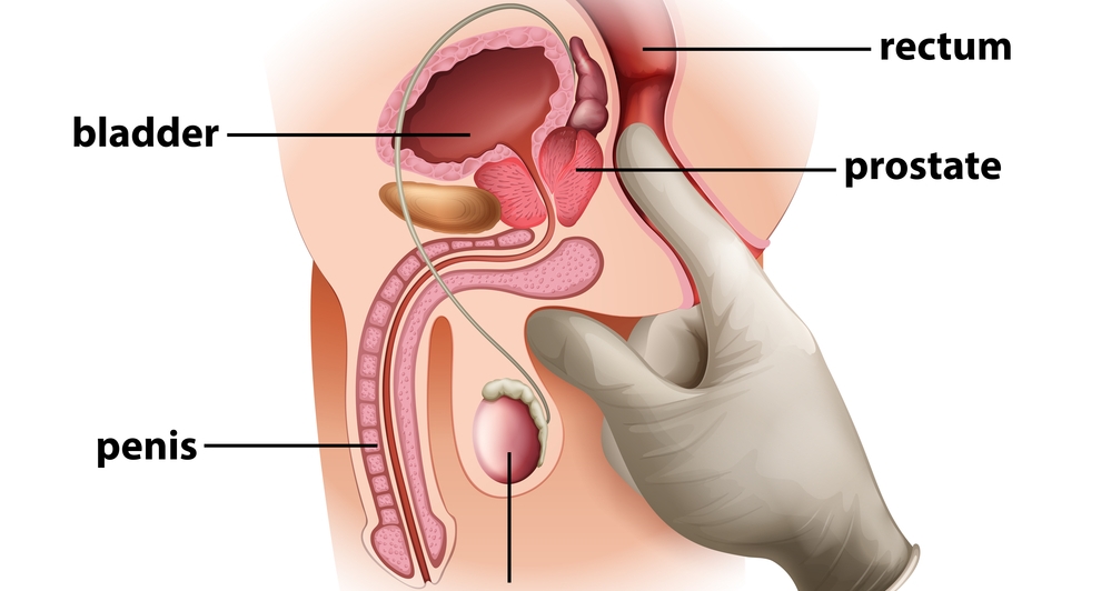 Prostate Rectal Exam - DRE