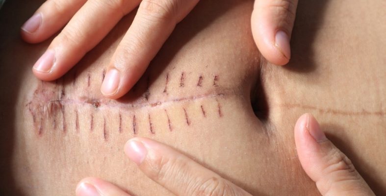 Scar Tissue Remediation for Sexual Organs | Genital Bodywork