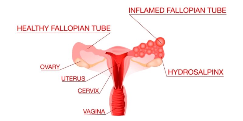 Treating Blocked Fallopian Tubes with Massage Therapy | Abdominal and Fertility Massage