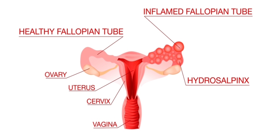 Inflamed and blocked fallopian tube