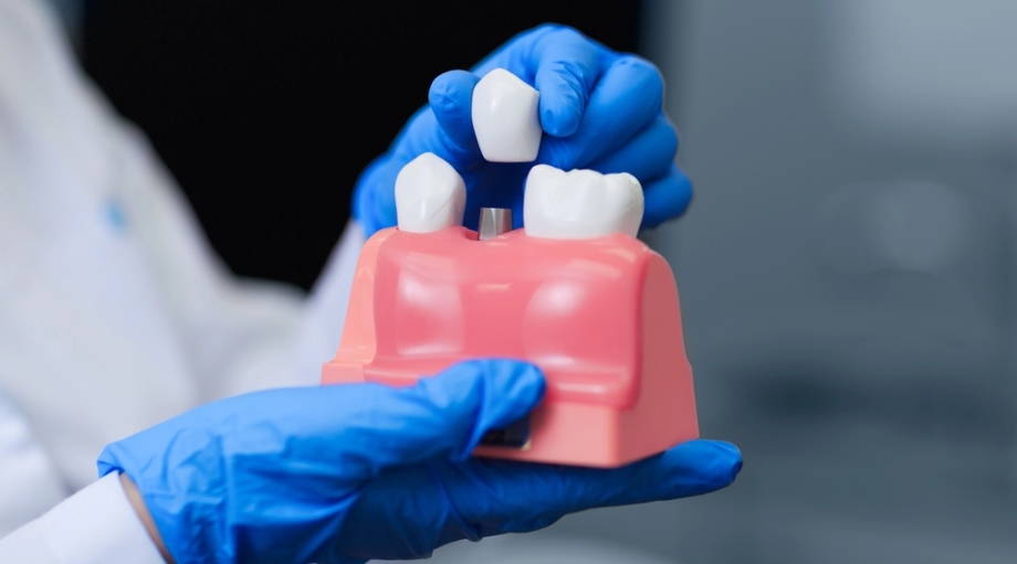 Dental implants model