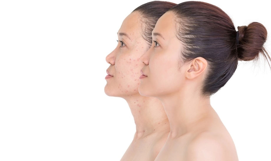 Laser Pigmentation Treatment for Asian Skin Tones in Singapore Example of a laser treatment result